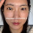 정성한의원 | [피부관리]청라_365정성한의원_미주안_스킨부스터/ 후기