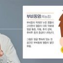 비인두암 증상 및 원인 (코피, 코막힘, 귀가 먹먹할 때) 이미지