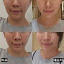 KJ모텔 | 다운타임 없고 안아픈 레이저리프팅 티타늄리프팅80kj 후기&amp;효과