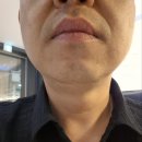센트럴성형외과 | 센트럴성형외과 후기, 울트라스킨 팔자주름리프팅 3040 남성 추천