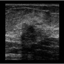 Benign lesions mimicking malignancy 이미지