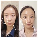 바른빛피부과의원 | 신사 피부과 디캐럿의원 신사본점에서 티타늄리프팅으로 신부관리