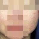 춘천주사피부염 극복을 위한 한의원 기준은