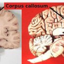 뇌량(corpus callosum) 이미지