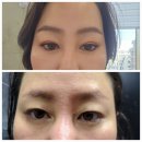 압구정웰약국 | 상안검 수술후기 (3개월후)