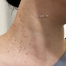 리샘한의원 대구점 | 대구 편평사마귀, 쥐젖, 점 가성비 제거 찐 솔직후기!