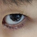 아이 안검내반 수술후기 초등 어린이