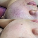 별가람약국 | [별내피부샵/알라딘필링 ]남양주 와이뷰라인에서 색소침착피부 관리