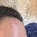 채움휴병원 | 망한 이마필러 녹인 후기(feat.필러는신중히)