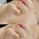 곳피티 | 서면 모공관리 잘하는곳, 피부피티센터에서 받은 세멘시트 관리 후기