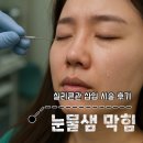 마       한       관 | 눈물샘 막힘 시술후기 실리콘 유류관 삽입시술