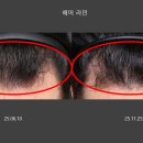 서울영등포초등학교 | 영등포구탈모병원｜리제네라액티바 탈모치료 7개월차 솔직 후기