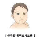 망막아세포종(Retinoblastoma) 눈질환, 소아청소년질환, 유전질환, 종양혈액질환이란. 이미지