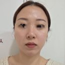 미모부심 | 일산 피부관리 미모부심 큐라젯 솔직후기, 이중턱 탄력부터 주의사항, 시술후 사진까지