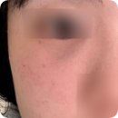 차오른치과의원 | [시술 후기] 울트라콜100 시술 후기 (1,2회차)