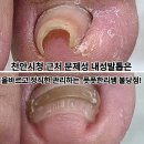 셀프케어 테이핑 건강교실 | 천안시청 근처 문제성 내성발톱은 올바르고 정직한 관리하는 풋풋한리쌤 불당점!