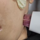 현메디케어 | 울써마지 후기 뷰티J메디스킨랩 대구 피부관리실 야간가능