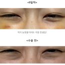 인일요양병원 | 웃을 때만 생기는 눈밑지 / 20대 눈밑지방재배치 수술 내돈내산 후기 (광고 X) / 당일-5일차