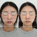 다솜약국 | 평택 밀도뷰티랩 첫 방문 후기 - 투턱소멸 윤곽관리