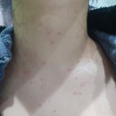 수원역광장 한의원 | 서울 편평사마귀, 쥐젖 제거 성지 정보, CO2 레이저로 제거 후기 (화곡 라르떼의원)