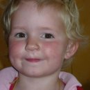 알레르기 이미지