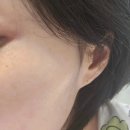 서울 송파 잠실새내역 눈가 리프팅 피아모리프팅|솔직 후기,가격