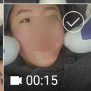 피부과 튠페이스 고주파 레이저로 얼굴 윤곽관리 후기
