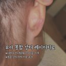 (주)브이아이앰 | 동탄 유아 봉합 후 상처 브이빔 레이저치료 내돈내산 후기