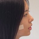 뭉툭 | 비개방코수술로 뭉툭하고, 낮은 코끝 높인 후기 (코젤코, 코끝연골묶기)
