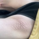 성화메디컬의원 | 강남 다한증보톡스후기! 넘치는 땀에 당황하지마시고 간단히 해결하세요(겨드랑이다한증, 두피다한증...