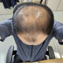 미니스톱울산인산병원점 | 비대면 탈모약 처방 내돈내산 이용 후기