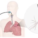 D00134 | 급성호흡곤란증후군