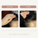 탑케어 | 강릉 시내 두피 케어 전문점 | 탑스칼프 관리 프로그램 후기