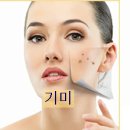 주근깨