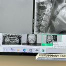 연세바로치과교정과치과의원 | 인천 구월동(연세바로교정치과) 내돈내산 치아발치교정 기록 | 첫번째