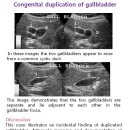 Congenital duplication of gallbladder 이미지