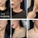 플레저성형외과의원 | [신논현 플레저성형외과] 튠팡페이스튠라이너 이중턱없애기 내돈내산 후기