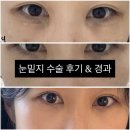 댕이멍이 | 대구 눈밑지방재배치 후기 / 눈밑지 자가지방이식 비용 경과 아이리쥬란 다크서클
