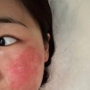 동탄디스퀘어앞 | [정에스테틱 동탄점] 비립종 부자의 눈물겨운 방황기, 압출 맛집 정에스테틱에서 비립종 빼기