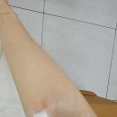 예스병원 | 갑상선 수술 후 3개월 피검사 결과 후기(양재역 8번 출구 예스클리닉)