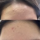 보금당약국 | #케토코나졸 연고 1주 후기 (#진균성 모낭염, #지루성 피부염)
