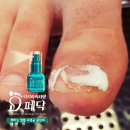 안산내성발톱 관리 후기 새 발톱 얻었어요♡