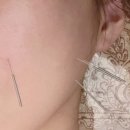 강동본한의원 | 전후 사진 ) 안면비대칭교정한의원, 가격도 좋은 1회 만에 달라진 얼굴 솔직 후기