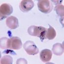 말라리아 증상 및 원인과 검사 백신 치료(약) : 모기 지역 전염 이미지