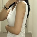 주사, 다이어트, 팔뚝 지방 분해 주사, 뉴핏 주사, 강남 피부과, 지방 분해주사 3회차 후기 _ 유진스 의원