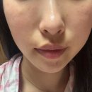240 | 김해 주촌 피부과 스킨부스터 콜라움 240 솔직 후기/비수면 마취 에어녹스