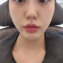내돈내산&gt;우유빛의원 눈밑cell주사 쥬베룩볼륨 솔직후기(눈밑꺼짐,다크서클)