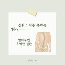 울산［필라테스 오르］질환 : 척추 측만증