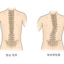 척추측만증(Scoliosis) 이미지