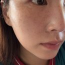 뷰티뷰 | 대전 잡티제거 효과최고 뷰티뷰 내돈내산 후기